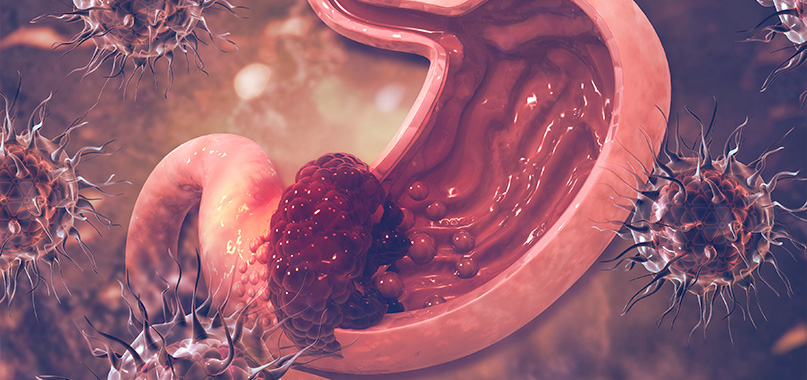 anaisa-portes-imagem-interna-cancer-de-estomago