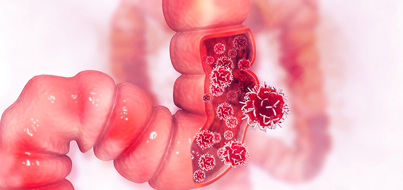anaisa-portes-imagem-interna-cancer-de-intestino