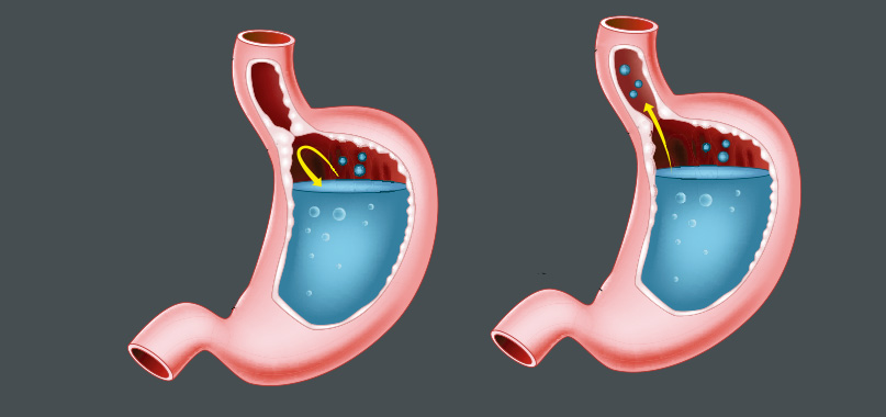 anaisa-portes-imagem-interna-cirurgia-de-refluxo
