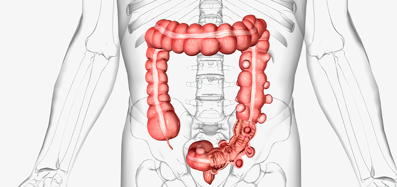 anaisa-portes-imagem-interna-diverticulite