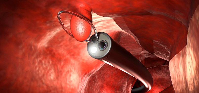 anaisa-portes-imagem-interna-polipo-intestino